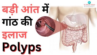 Polyps  बड़ी आंत में गांठ की इलाज  Polyps Symptoms Causes amp treatment [upl. by Htebi]