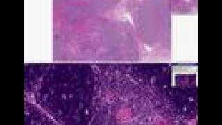 Histopathology ThymusThymoma [upl. by Bouzoun805]