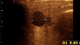 Parotitis  Lymphadenitis  Normal Thyroid Gland [upl. by Laroc390]