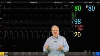 Philips IntelliVue Patient Monitoring  6  Changing a Wave [upl. by Ennahgiel279]