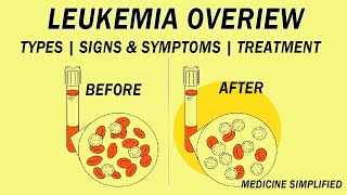 What is Leukemia  Classification Etiology Pathophysiology Clinical Features and Treatment [upl. by Souvaine32]