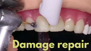 Front teeth damage repair  front teeth filling process  cavity filling [upl. by Ylrevaw948]