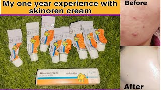 Skinoren creamSkinoren cream reviewsAzalic acid before and after [upl. by Yrelle194]