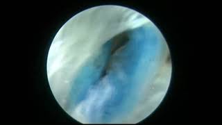 Endoscopic Application of a Collagen Scaffold for Treatment of Achilles Tendinopathy [upl. by Noislla40]