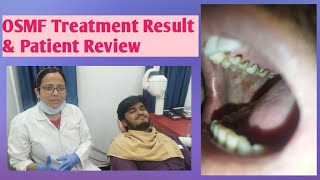 Oral Submucous FibrosisPatient Review and Treatment of OSMFOSMF and its CureOsmf kaise thik kre [upl. by Airdnoed]