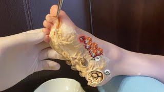 Doctor saved the Foot from parasites and barnacles  ticks removal [upl. by Gay648]