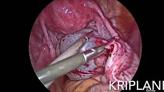 Prof Dr Alka Kriplani  Lap Paraovarian Cystectomy [upl. by Sitnalta409]