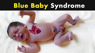 Cyanosis  Blue Skin Color in babies  Symptoms Causes and Treatment UrduHindi [upl. by Esor]