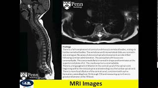 Syrinx spinal cord cyst [upl. by Atoked]