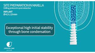 JDimplant Ø43 L13 drilling protocol in healed bone and post extractive sockets [upl. by Nanyk]