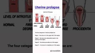 Uterine prolapse  viralshorts uterus uterineprolapse obgy [upl. by Mafala71]