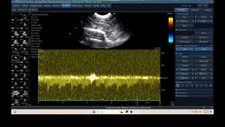 IQ 300 TCD BRAIN ICP CPP ULTRASOUND HWD ECHOPAC ANALYSIS [upl. by Najar]