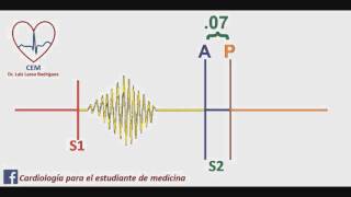 Soplo de la comunicación interauricular [upl. by Thanos]