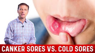 Canker Sores Vs Cold Sores – Dr Berg on Mouth Sores [upl. by Arukas560]