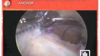 Arthroscopic rotator cuff repair L shape tear [upl. by Ekul162]