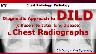 CXR Diagnostic approach to DILD diffuse interstitial lung disease [upl. by Pasho]