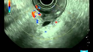 Endoscopic Ultrasound Examination of the Papilla and the Biliary System [upl. by Simpson]