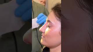 NOSE JOB IN TEN MINUTES plasticsurgery filler liquidrhinoplasty [upl. by Erual]