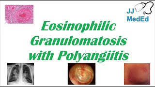 Eosinophilic Granulomatosis with Polyangiitis EGPA  ChurgStrauss Syndrome Autoimmune Vasculitis [upl. by Vinay]