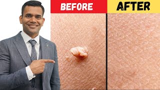 Remove Skin Tags and Warts Within 24 Hours  DrVivek Joshi [upl. by Amabel297]