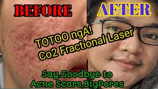 co2 fractional laser  totoo nga sya😍 Honest Review 2021 [upl. by Oiznun594]