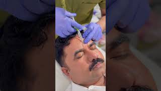 Forehead Filler  Micro Needling  face treatment  Face Glow [upl. by Eart872]