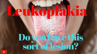 LEUKOPLAKIA Premalignant condition of oral cavity [upl. by Anead]