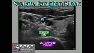 Stellate Ganglion Block for PTSD [upl. by Ennahteb]