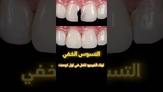 التسوس الخفي Hidden tooth decaydrabdullahsultandentist اسنان dentistry دكتور ترند اكسبلور [upl. by Domash]