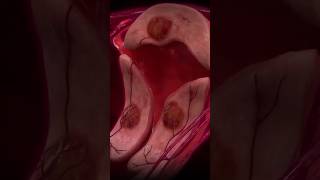 How Does Uterine Fibroid Embolization UFE work uterinehealth womenshealth healthshorts shorts [upl. by Cran664]