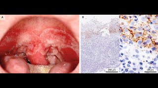 Syphilitische Pharyngitis [upl. by Acenom]