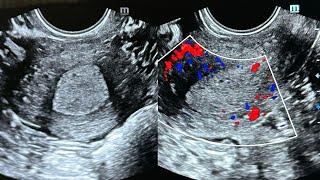 Thickened endometrium  Drpruthvirajmo [upl. by Einiffit977]