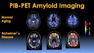 Early Detection and Prevention of Alzheimers Disease Video  Brigham and Womens Hospital [upl. by Ayle]