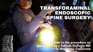 My technique for transforaminal endoscopic spine surgery [upl. by Orella]