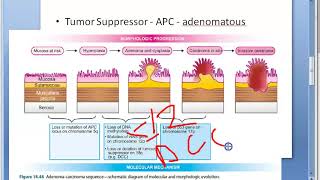 Pathology 521 h AdenoCarcinoma Colon sequence colorectal cancer tumor mutation DCC genetics [upl. by Aihsit1]