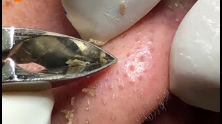 Best Satisfying Nose Plucking Blackheads Whiteheads Removal  Acne Treatment 13 [upl. by Je801]