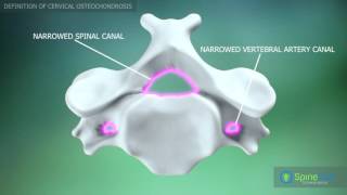 Cervical Osteochondrosis Definition [upl. by Rayna]