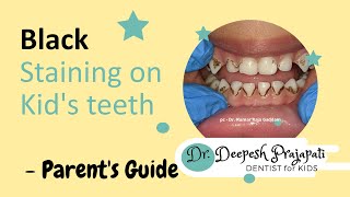 Black staining on kids teeth  Guide for Parents [upl. by Blanka404]