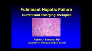 Fulminant Hepatic Failure Current and Emerging Therapies [upl. by Guenevere190]