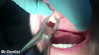 Extraction Of Molar Tooth [upl. by Euginom]