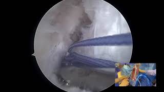 Posterior Lateral Meniscal Root Repair Through Lateral Tunnel and Anterior Cruciate Ligament Revisio [upl. by Culhert]