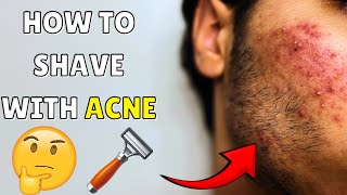 WATCH THIS BEFORE SHAVING WITH ACNE [upl. by Rustice]