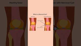 Connections between Meniscal Tears and Parameniscal cyst  Dr Jeya Venkatesh [upl. by Anneehs409]