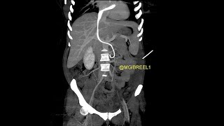 Intracardiac migration of ureteral doubleJ stent till the PV level [upl. by Nancee]