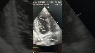 Apical thrombus echocardiography cardiacimaging cardiology [upl. by Lisha]