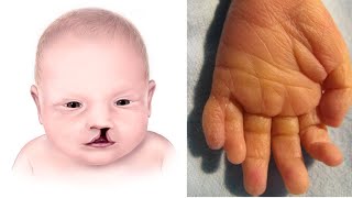 What is Patau Syndrome Trisomy 13  Symptoms [upl. by Mack]