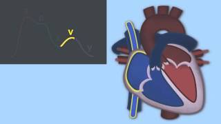 Interpreting Central Venous Pressure Waveforms by J DiNardo  OPENPediatrics [upl. by Dlnaod349]