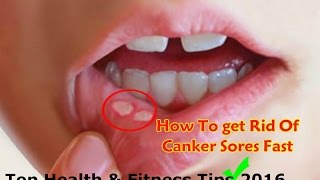 How to Get Rid Of Canker Sores in Mouth and Tongue Home Remedies [upl. by Donica989]