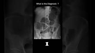 Ulcerative colitis  Toxic megacolon Abdominal Xray  Abnormalities 87 radiologychannel007 [upl. by Dyanna]