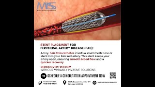 PAD Treatment Without Surgery Nonsurgical Stent Placement [upl. by Stander]